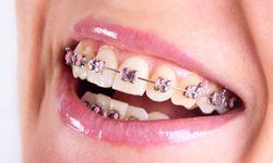 Orthodontic Elastics FAQs, WNY Orthodontists